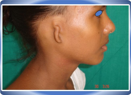 EAR RECONSTRUCTION